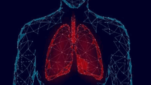 Severe Respiratory Infections Linked to Subsequent Lung Cancer
