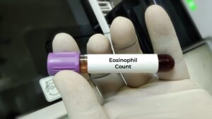 Eosinophil Counts, FeNO May Predict Asthma, COPD Exacerbations